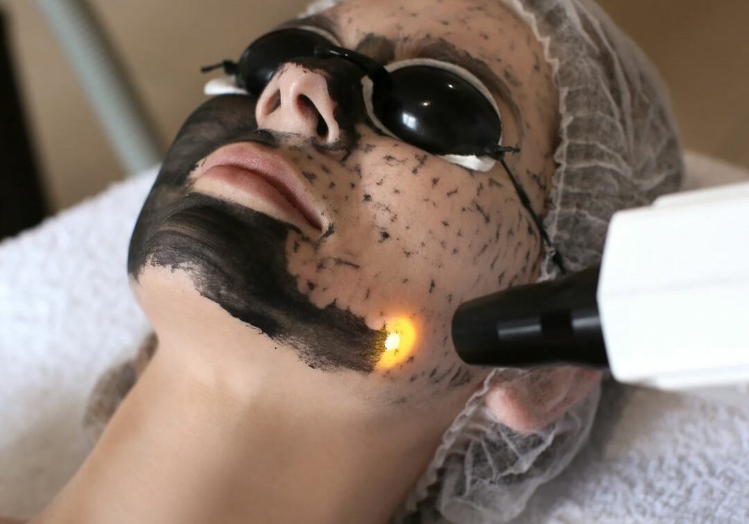 carbon peeling carbon peeling